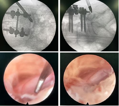 7毫米创口终结十年痛楚 哈医大一院群力骨科王岩松团队脊柱微创技术新突破